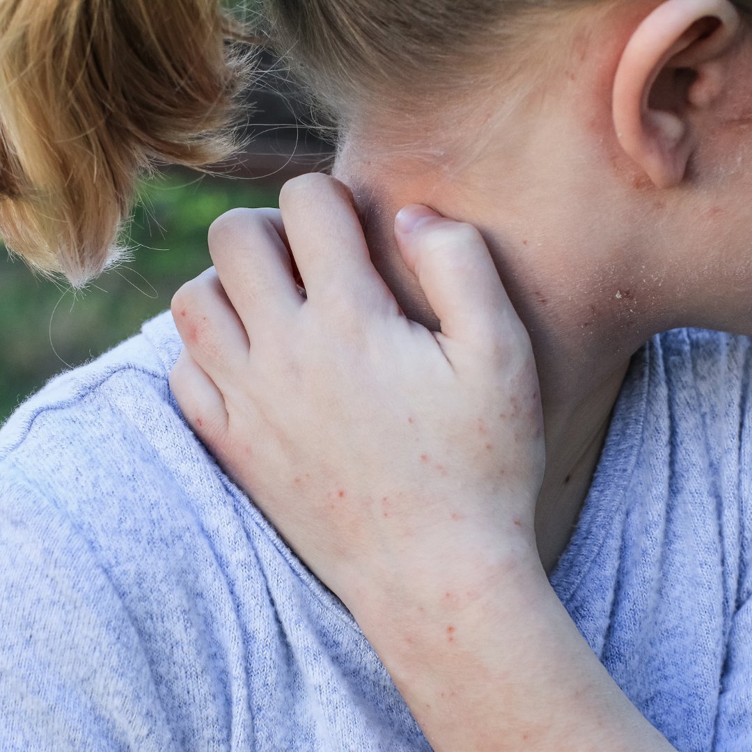 RelieveAllergy's tweet image. Did you know that there are several types of eczema? Do you know which type you have? 🤔 If you don&apos;t, that&apos;s okay because we can help. 🙌 Diagnosing and managing eczema is what we do. 🥳 Contact us today! 480-500-1902

#Eczema #Hives #AllergySolutions #AllergySolution #Allergies