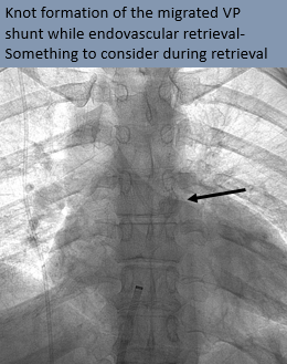 Rakesh Varma (@rakeshkvarma) on Twitter photo Clinical Pearls in IR 19: Accidental transvenous tunneling of VP shunt through neck veins can result in intravascular migration of the catheter, causing shunt malfunction/arrhythmias/PE. Retrieved <a href="/uab_ir/">UAB IR</a> <a href="/ISVIRIndia/">ISVIR India</a> <a href="/SIRRFS/">SIR RFS</a> <a href="/SIR_ECS/">SIR ECS</a> <a href="/SIRspecialists/">Society of Interventional Radiology</a> bit.ly/3aP0TtT Clinical Pearls in IR 19: Accidental transvenous tunneling of VP shunt through neck veins can result in intravascular migration of the catheter, causing shunt malfunction/arrhythmias/PE. Retrieved <a href="/uab_ir/">UAB IR</a> <a href="/ISVIRIndia/">ISVIR India</a> <a href="/SIRRFS/">SIR RFS</a> <a href="/SIR_ECS/">SIR ECS</a> <a href="/SIRspecialists/">Society of Interventional Radiology</a> bit.ly/3aP0TtT