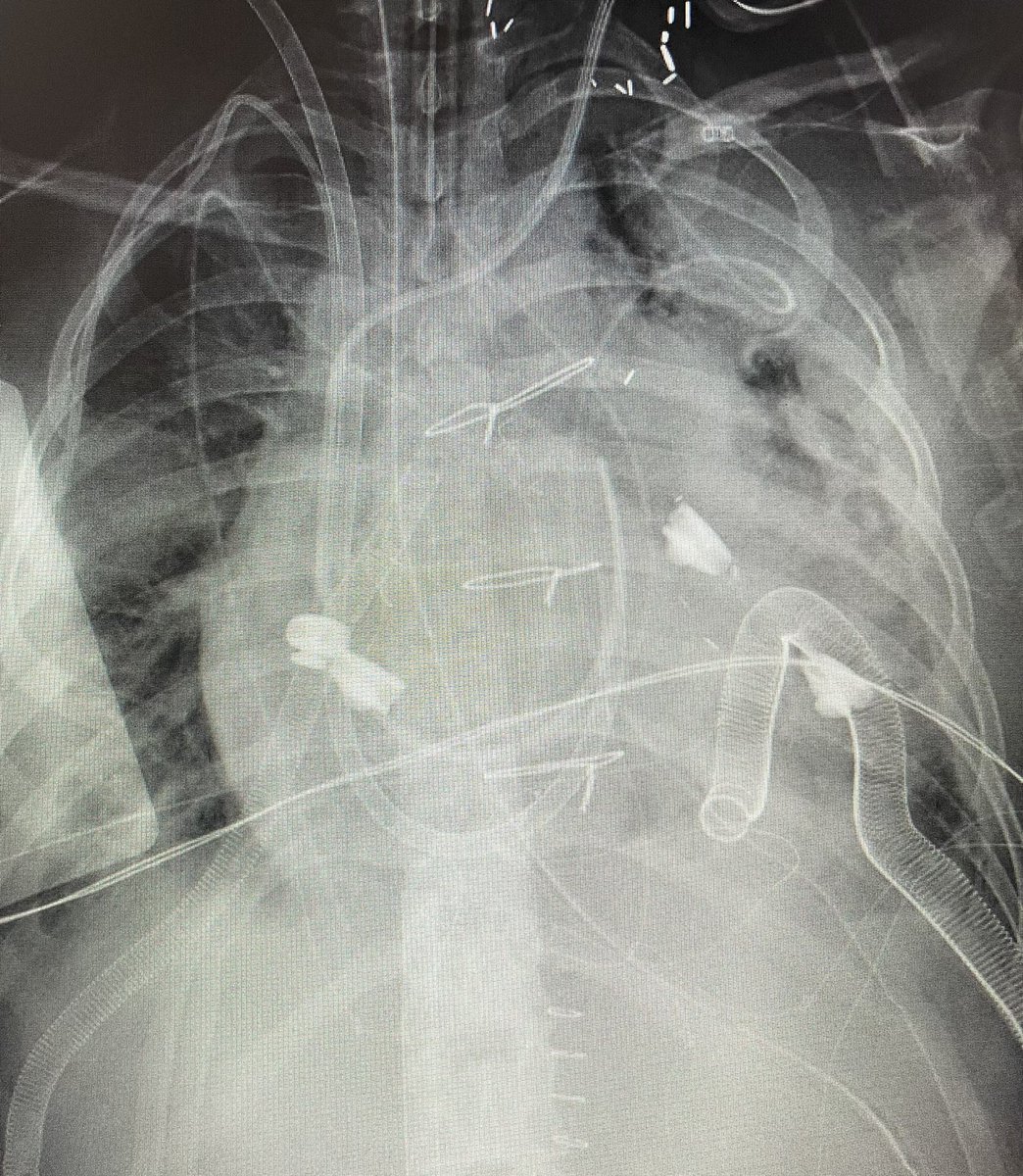 Toto, I have a feeling we’re not in the ED anymore.

Interpreting CXRs in the CTICU is a whole new ballgame. 2 weeks into fellowship and I continue to be in awe of the miracles performed in this unit every day.