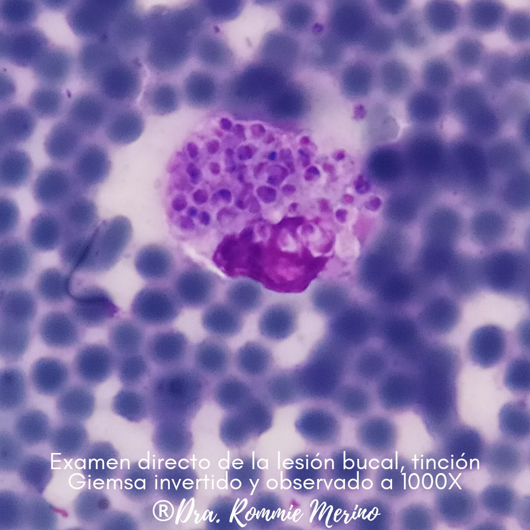 Rommiemicologia's tweet image. Disseminated histoplasmosis with oral lesions in an HIV/AIDS male patient. This case surprised me. I really expected Paracoccidioides due to particular oral manifestations (in our experience, most oral manifestations are due to PCM), but we found abundant intracellular yeast 🍄