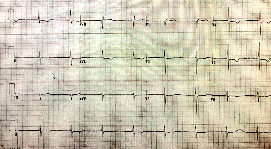 Pt weak, lightheaded, 911 called. ▪️First EKG is from EMS, performing transcutaneous pacing. ▪️Second EKG is in ER. What's going on?