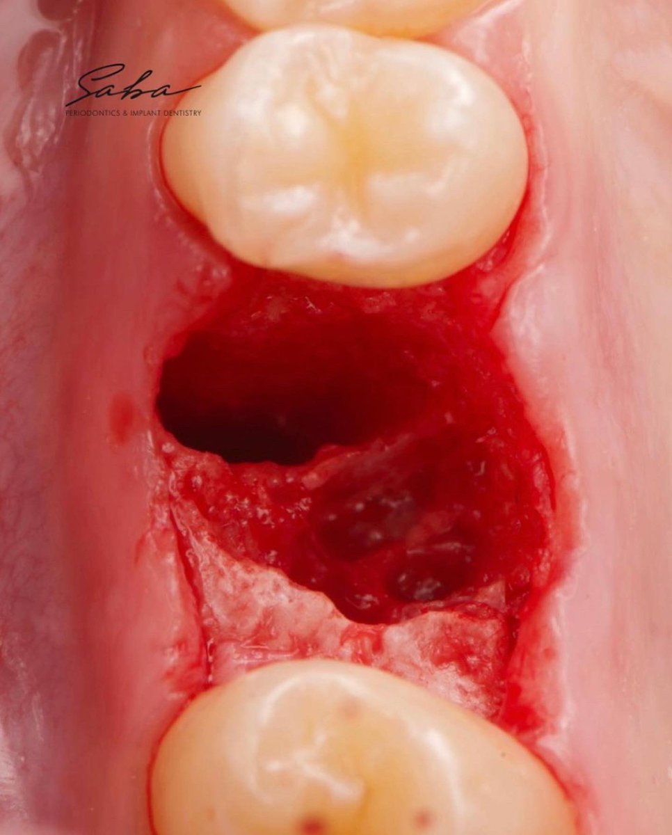 dentiscope's tweet photo. What do you think is going on and how would you approach this case? 

Swipe left 👈 to see how did we approach the case!

And lets not forget that I shoot with @flashkap 

Material used: 

🦷Allgraft+ Bioss mix @geistlich_north_america 

🦷BioXclude membrane @snoasismedical https://t.co/045ObLJqso