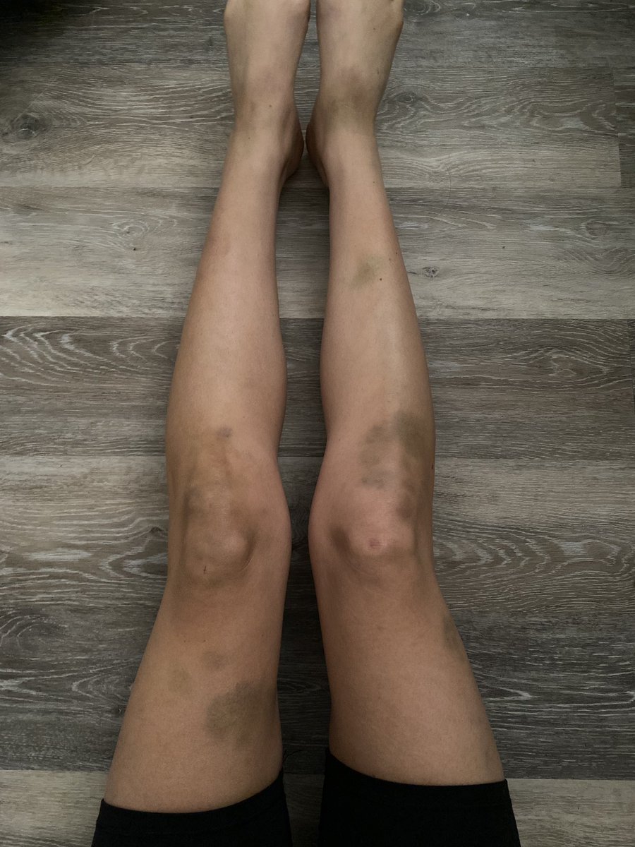 andjustysaid's tweet photo. @macieillyes update on my legs…does this make it real enough now for all the people saying, “just a rock?” https://t.co/HqKXmk6h0T