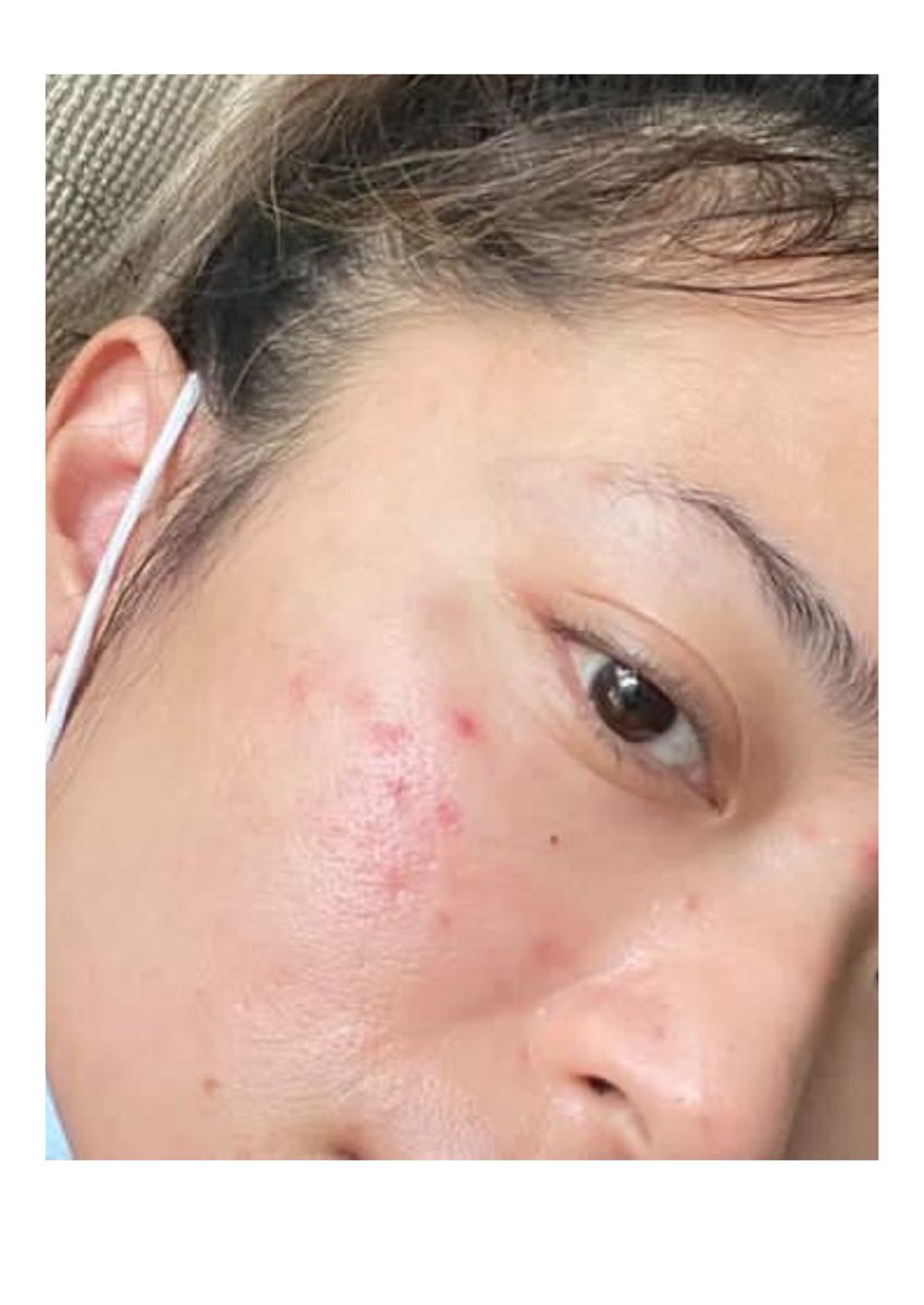 Tips sembuh dari jerawat:
- Jaga pola makan
- jaga kebersihan kulit wajah
- jangan di pikirin,nanti makin parah🤫
- perbaiki cara pake skincare
- pake acne combo dari Purivera ✨

*before after setelah menggunakan White Willow Toner &amp; Blue Grapeseed Serum Oil💖
#skincare #acne