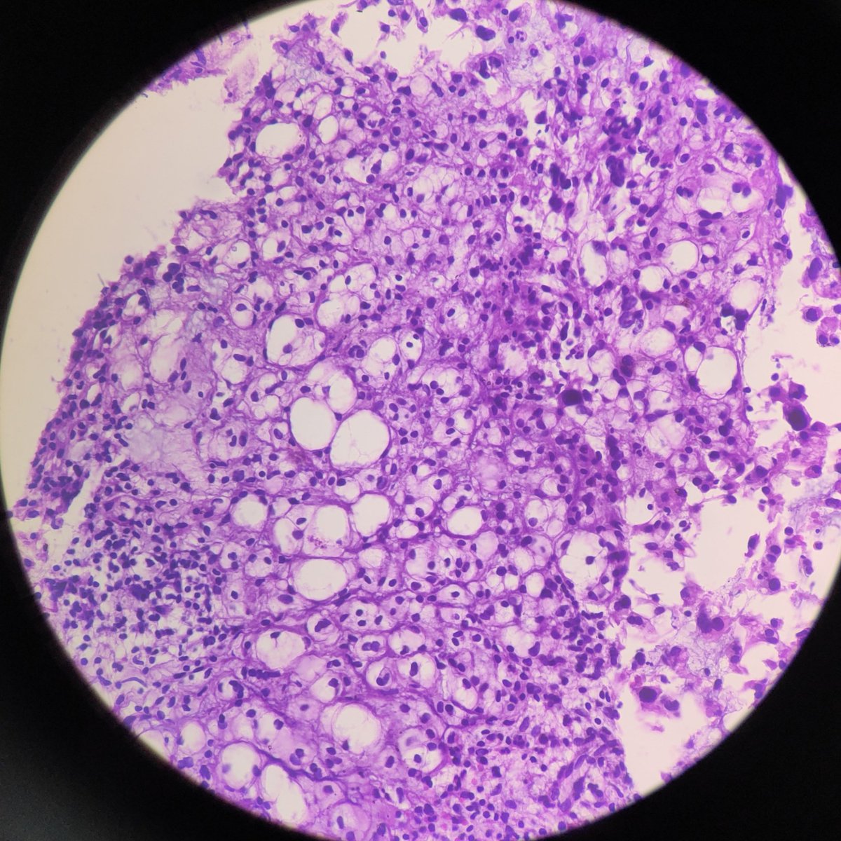 Shruti79688953's tweet photo. Sacrococcygeal lesion #chordoma #histology #pathlove #pathtwitter https://t.co/T1Q9bmOtOp