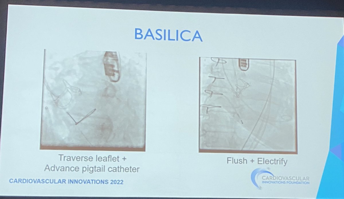 EZancanaroMD's tweet photo. 2/2 Are you aware of the NEW #TAVR BASILICA??
🧐📢🚩📰⬇️
#cvi2022 #CardioTwitter #CardioEd #JACCINT #TAVR #InstaCardio #WomenInCardiology #ACCIC #ACCEd @JACCJournals @cvinnovations @PCRonline #EAPCI @ACCinTouch @GilbertTangMD @drmaisano @ABeneduceMD @SRValveCenter https://t.co/tWjqJqOVeD