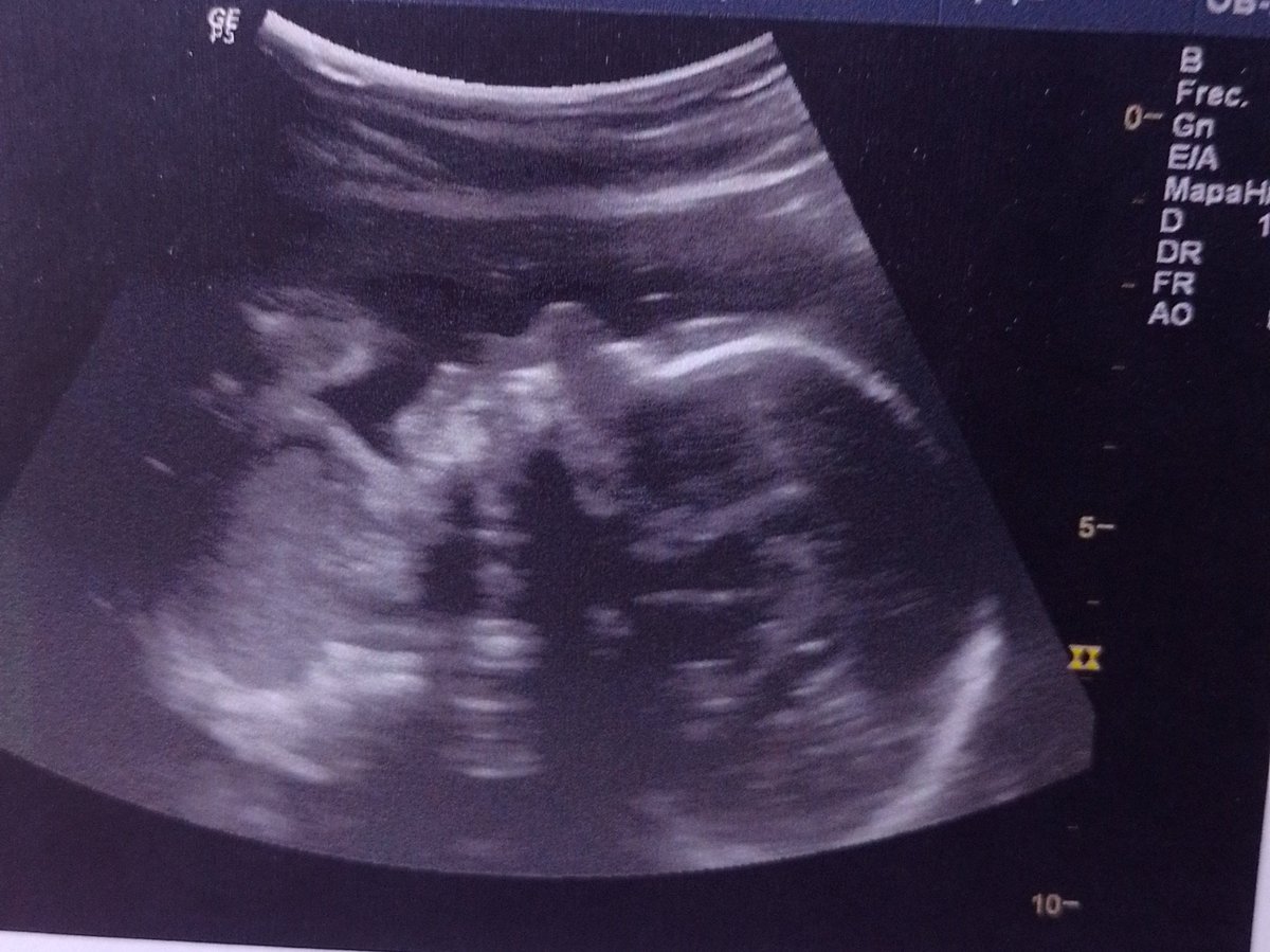 Mi pequeña,me pone contenta saber que estás creciendo fuerte y sanita ❣️hiciste que mi vida cambiará por completo ,te amo y espero con todo el amor del mundo mi bebé chiquita🥰😍
ámbar nicolle