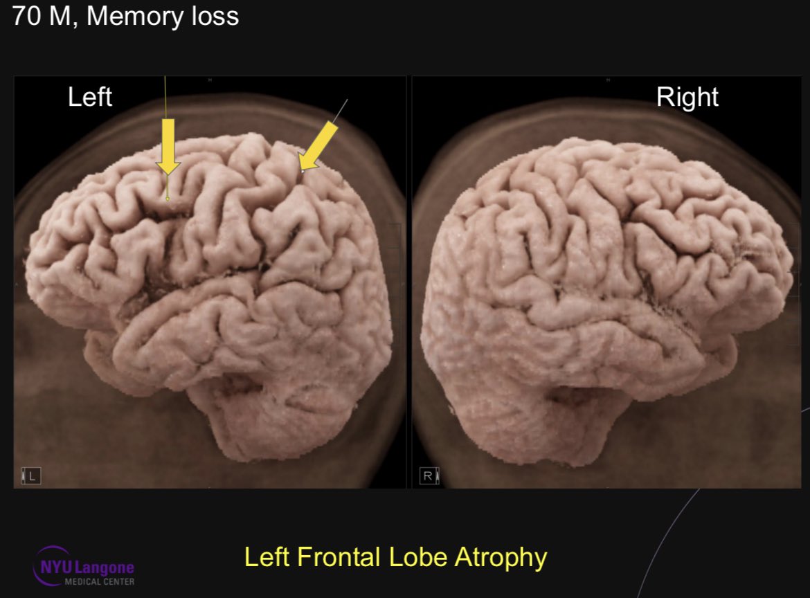 Will anyone call focal or asymmetric atrophy on just the cross-sectional imaging? I was not till saw the cinematic renderings which show a fairly convincing left frontal lobe atrophy. Diagnosis not known yet as patient will undergo PETMR & neuropsychological assessment.