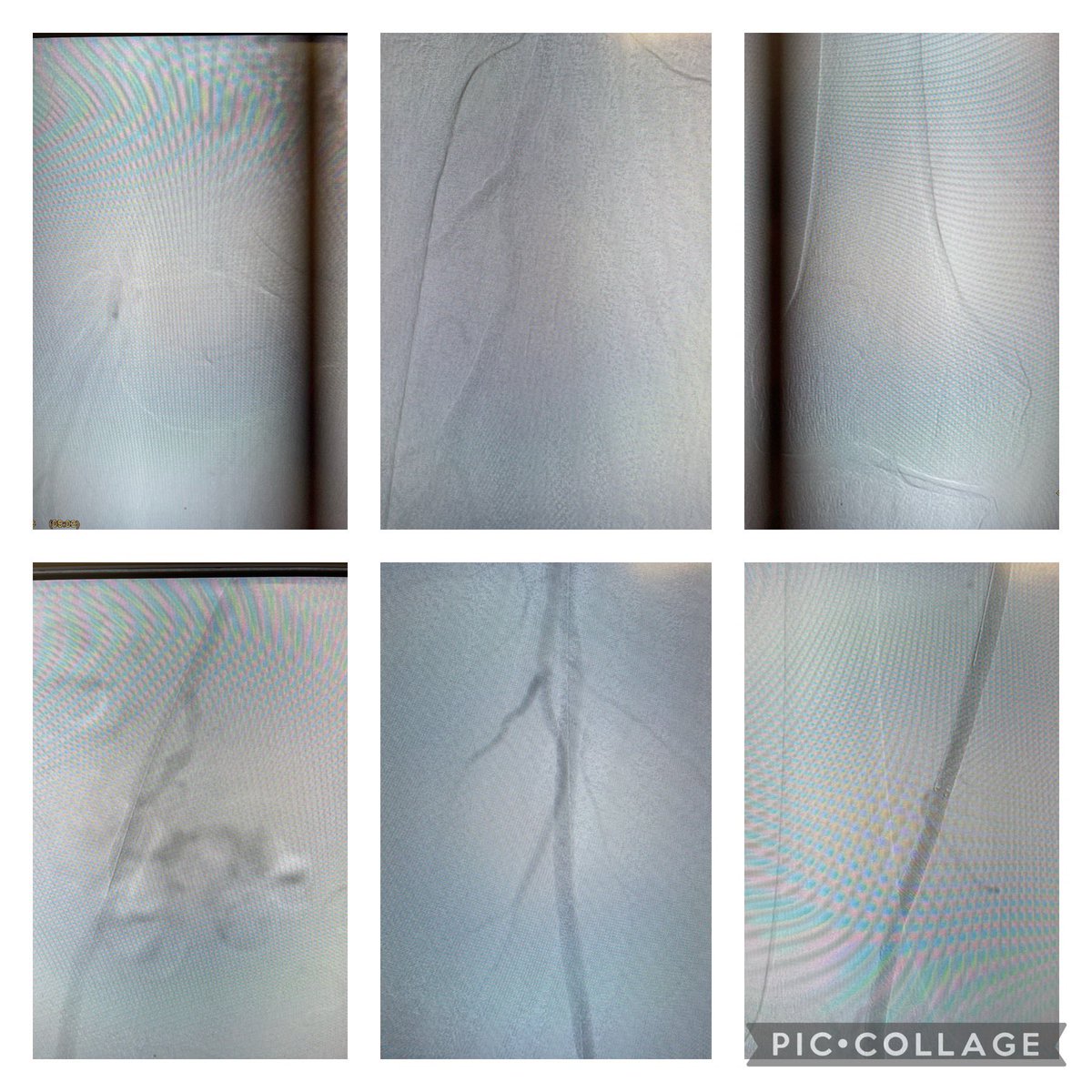 omarsaleh66's tweet photo. External iliac and sfa/pop occlusion treated w #rotarex #irad https://t.co/0bI8DqOoPM