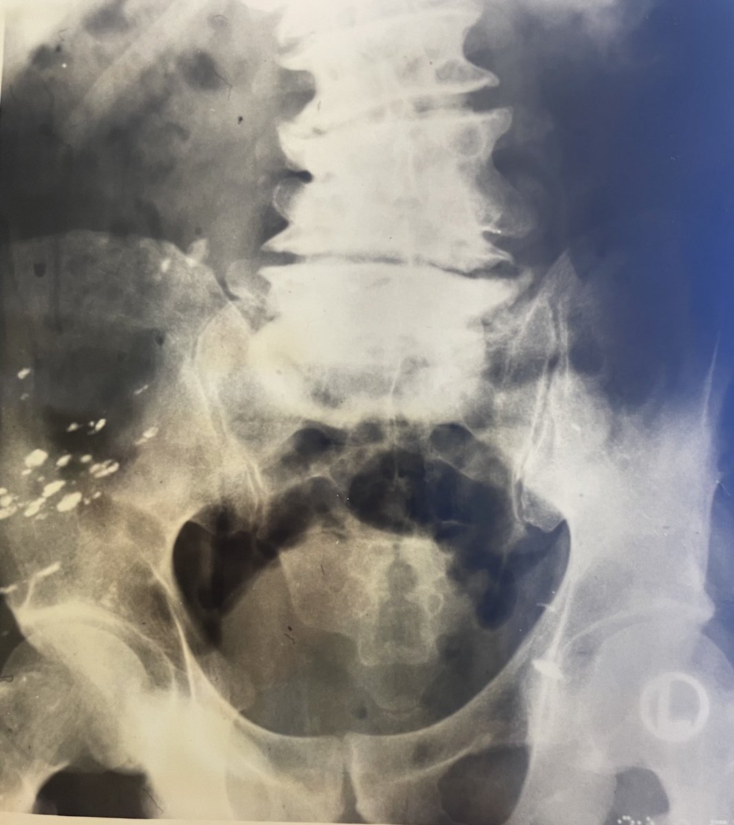 abdominal X-ray from 1950’s showing collapsed vertebrae and radiopaque material in buttock: SYPHILITIC CHARCOTS ARTHROPATHY TREATED WITH BISMUTH! ( pre-penicillin therapy)