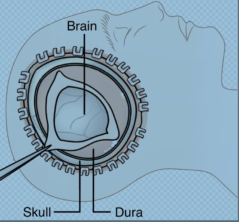 Patients had a decompressive craniectomy after serious #TraumaticBrainInjury with elevated intracranial pressure were twice as likely to improve than ppl getting standard care, finds <a href="/RESCUEicp/">RESCUEicp</a> trial. <a href="/ag_kolias/">Angelos Kolias</a> @CAMNeuro @AANMember #neurotwitter bit.ly/3B7WrBc