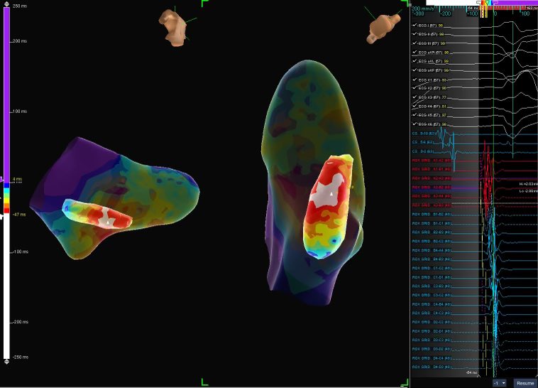 arcampado's tweet image. Another great PVC ablation with @ashu18383. Papillary muscle PVC EGMs bracketed on #HDGrid. PVC successfully suppressed with first RF application. Map credit: @ryancolemaps @AbbottCardio  #mapmoreburnless