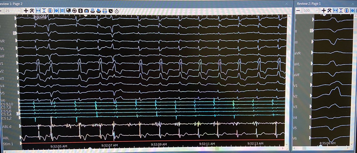 arcampado's tweet image. Another great PVC ablation with @ashu18383. Papillary muscle PVC EGMs bracketed on #HDGrid. PVC successfully suppressed with first RF application. Map credit: @ryancolemaps @AbbottCardio  #mapmoreburnless