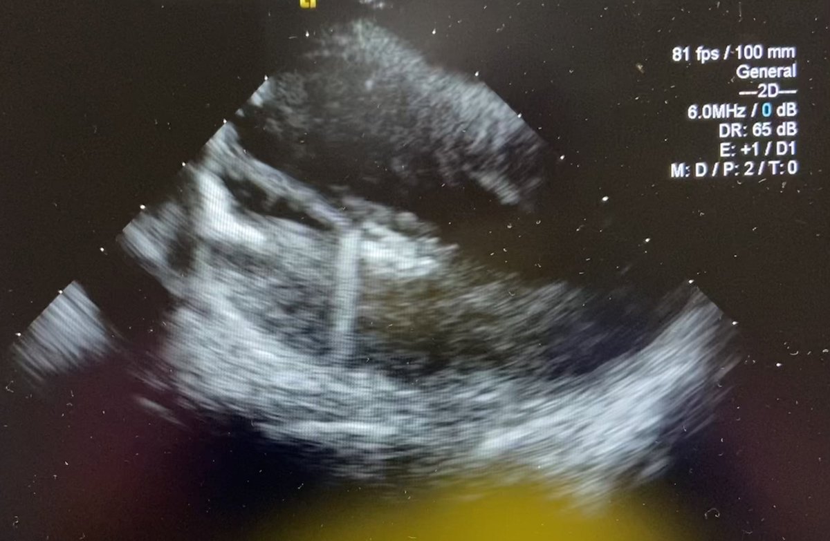arcampado's tweet image. Another great PVC ablation with @ashu18383. Papillary muscle PVC EGMs bracketed on #HDGrid. PVC successfully suppressed with first RF application. Map credit: @ryancolemaps @AbbottCardio  #mapmoreburnless