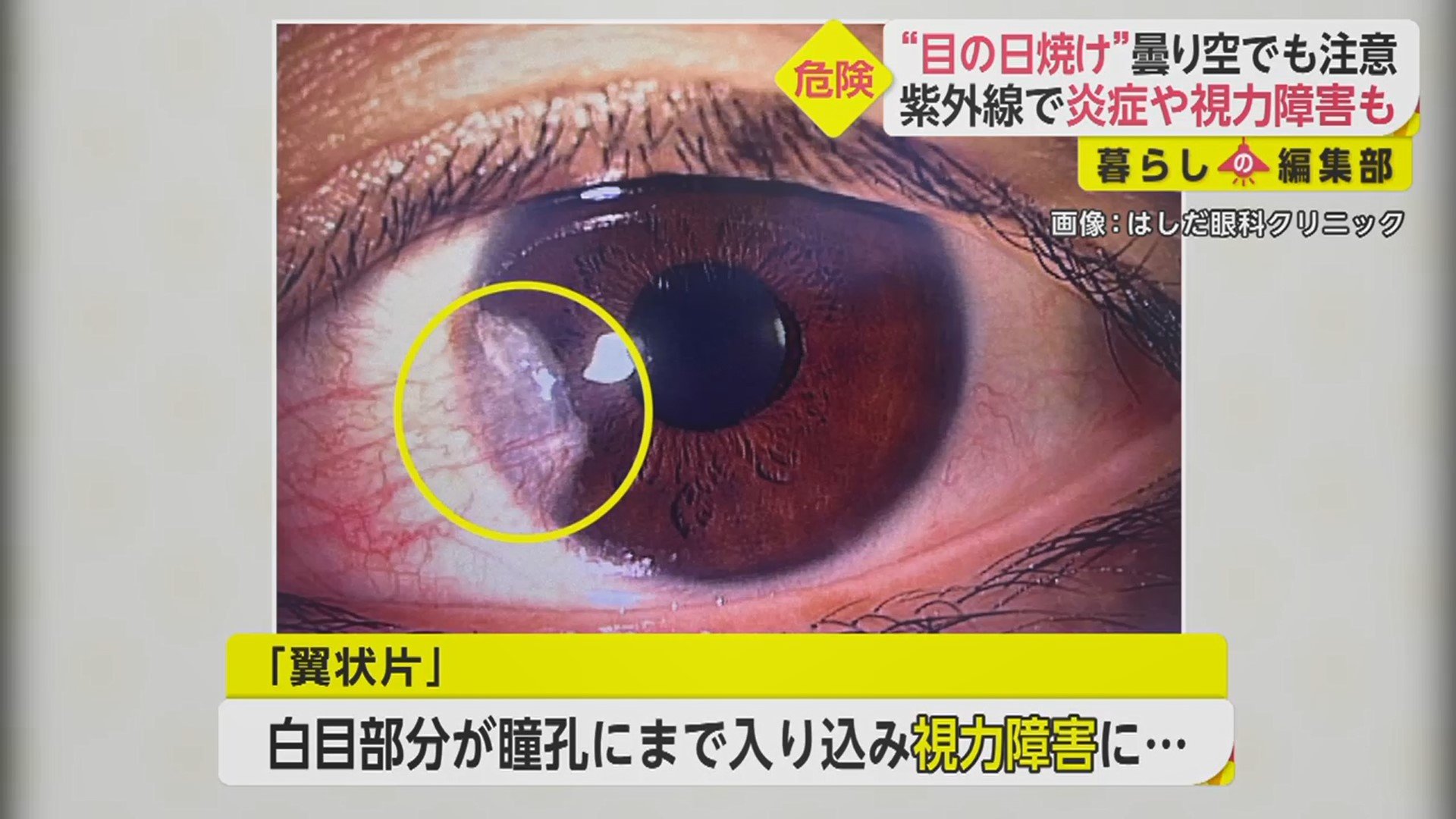 やさひふ 皮膚科専門医 医学博士 Lumedia編集長 スイスの論文によると 中型サングラス 片目辺り5 3cm 5 7cm 目にかなり紫外線が入る 大型サングラス 5cm 8cm 一部はそれなりに紫外線が入る ゴーグル ほぼ完璧に紫外線を遮断 という結果でした