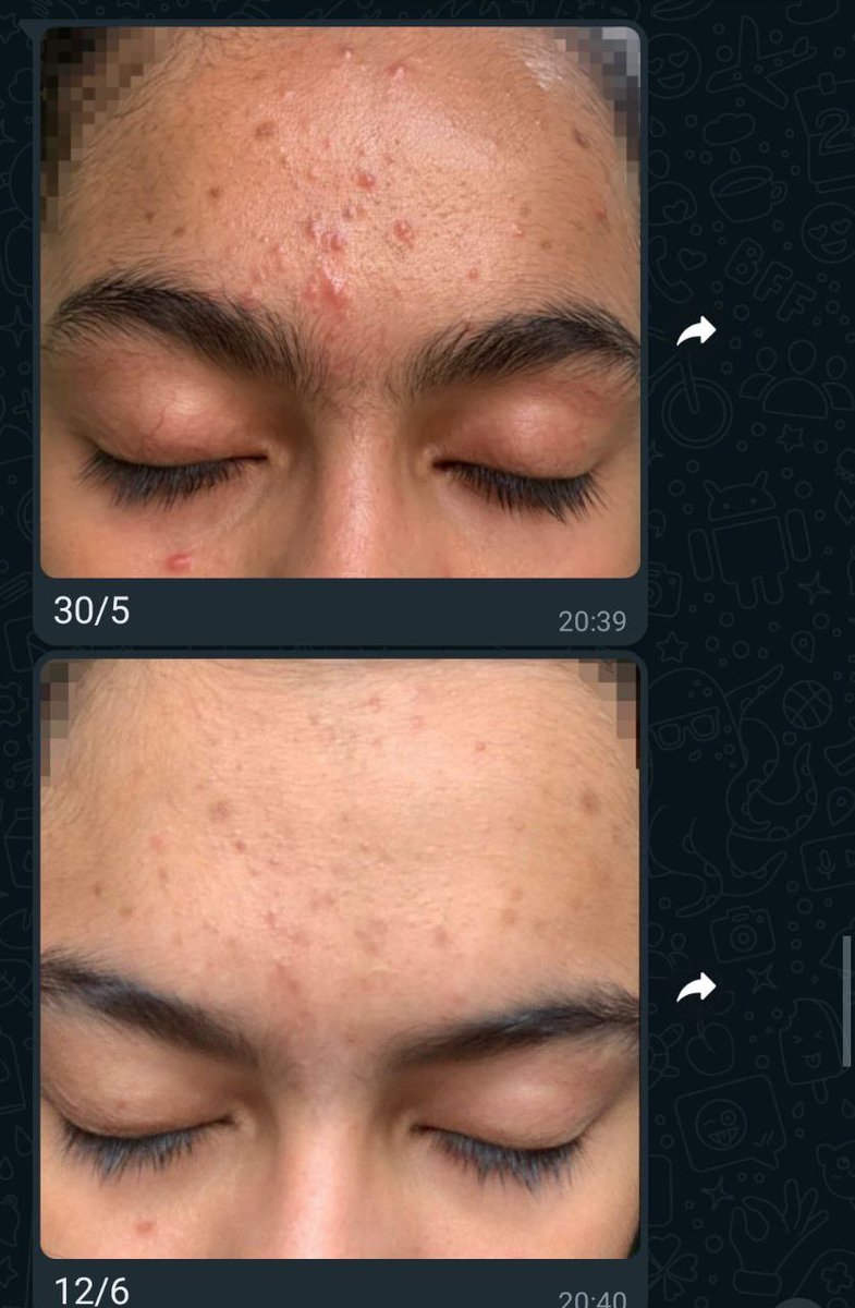 theskincare_'s tweet photo. My holy grail cleanser for acne prone and oily skin✨

Love giler dengan 𝙳𝚊𝚒𝚕𝚢 𝙳𝚎𝚎𝚙 𝙲𝚕𝚎𝚊𝚗𝚜𝚎𝚛 ni sebab ada ingredients AHA BHA yg akan deep cleanse skin sampai ke dlm pori &amp; tak rasa tight✨

DDC can used as daily cleanser as it's have pH 5.5 level✨ https://t.co/z5XyC9sqfU