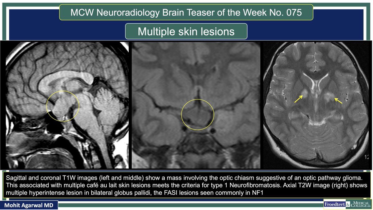 PublishedXPrime's tweet photo. #MCWNeuroradBTW 075Ans: NF1

#TeachingMoment on NF1 spectrum

#FOAMed #radres #MedEd @TheASNR @ARRS_Radiology @BSHNI_UK @ESNRad @BshniTrainees @ESHNRSociety @bdoop3210 @MCWNeurorad @AwanRad @aaronrutman @RadDiscord @ASHNRSociety @AURtweet @FatimaElahi21 @drSurjthVattoth https://t.co/sdx05xi8Sv