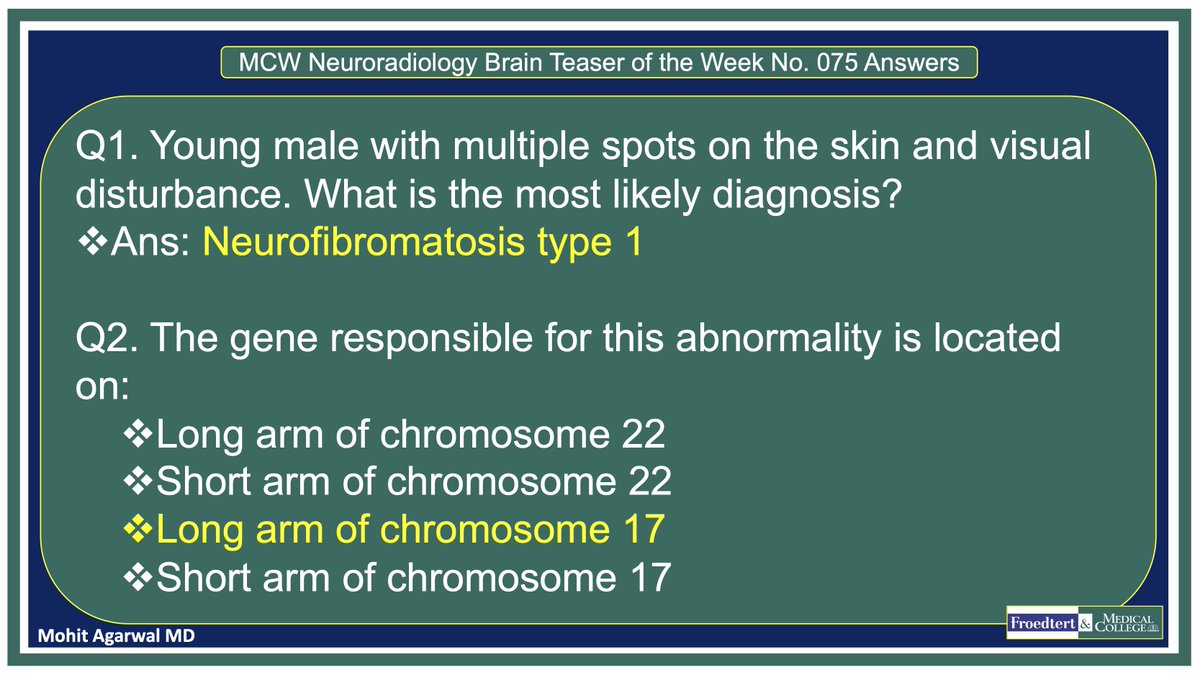PublishedXPrime's tweet photo. #MCWNeuroradBTW 075Ans: NF1

#TeachingMoment on NF1 spectrum

#FOAMed #radres #MedEd @TheASNR @ARRS_Radiology @BSHNI_UK @ESNRad @BshniTrainees @ESHNRSociety @bdoop3210 @MCWNeurorad @AwanRad @aaronrutman @RadDiscord @ASHNRSociety @AURtweet @FatimaElahi21 @drSurjthVattoth https://t.co/sdx05xi8Sv