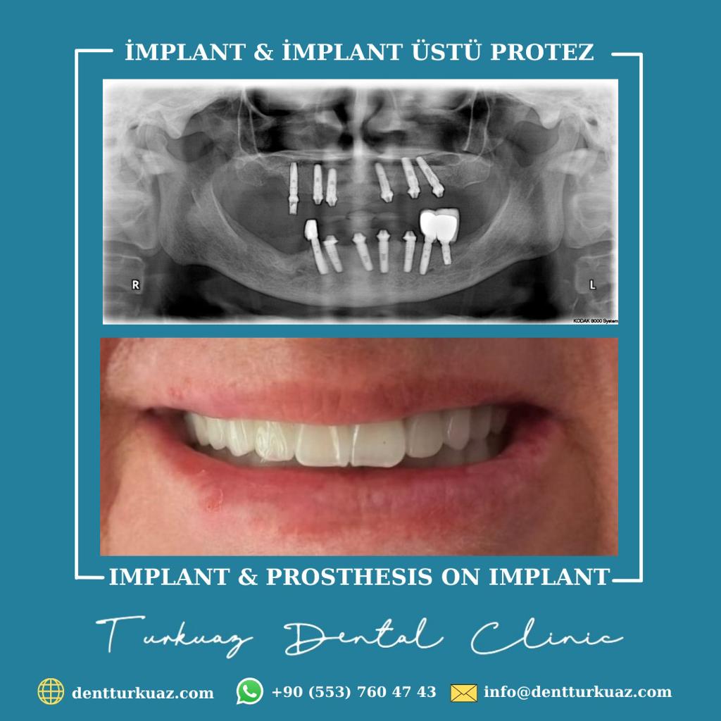 TurkuazDis's tweet photo. https://t.co/RJ7IICcM8Z
WhatsApp Randevu: +90 553 760 47 43
Turkuaz Ağız ve Diş Sağlığı Poliklinikleri
#implanttedavisi #dişetitedavisi #turkuazdentalclinics #healthtourismturkey #dentturkuaz #kadıköy #istanbul #diseti #ortodonti #dtihsanözal https://t.co/oF68fJIwtU