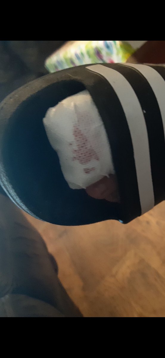 HardcoreGym1's tweet photo. Hope doesn't effect me squats tomorrow #ingrowingtoenail https://t.co/z7hLyK6pCO