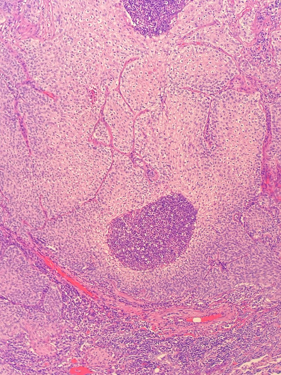megothelioma's tweet photo. Love when the IHC (p40) perfectly confirms your morphologic suspicion (SCC)
#PathTwitter #BasicPath https://t.co/n0KbrrMcZP