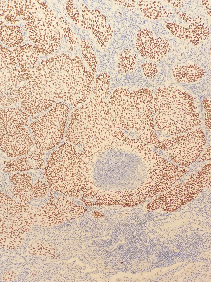 megothelioma's tweet photo. Love when the IHC (p40) perfectly confirms your morphologic suspicion (SCC)
#PathTwitter #BasicPath https://t.co/n0KbrrMcZP
