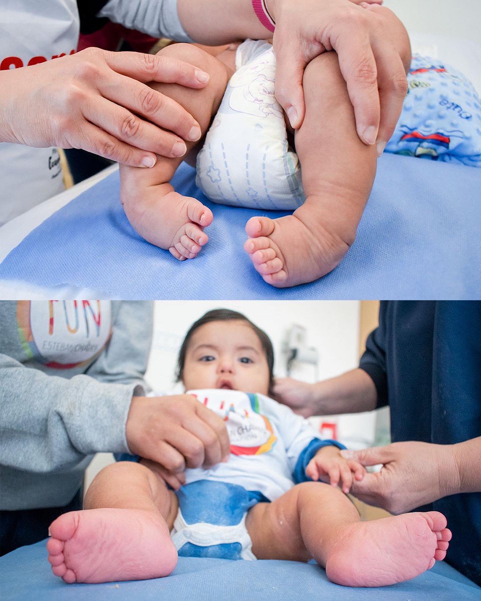 👣¿Sabes qué es Pie Equino Varo? 👣 ➡️Es una condición, en la cual los niños y niñas nacen con los pies hacia adentro 👶🏻¿Y su tratamiento? ➡️Con el Método Ponseti, que es una serie de yesos y una tenotomia, los pies pueden volver a su forma original 😍