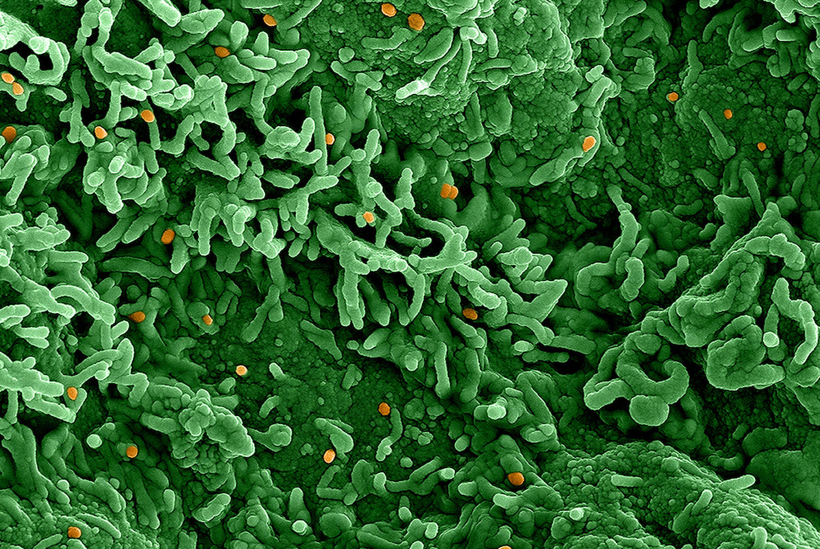 QuebecScience's tweet photo. Les cas de variole du singe continuent à grimper : plus de 13 000 ont été signalés à l’échelle mondiale depuis mai 2022. Que disent les séquences génétiques du virus de la variole du singe?
https://t.co/Nmf4bMCEXH https://t.co/T4eC4DTC2Z