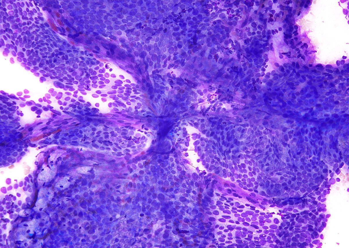 sza_jhcyto's tweet photo. "The Feeders" - Crisscrossing capillaries, Papillary Thyroid Carcinoma, FNA. https://t.co/XnEEWtvRw4