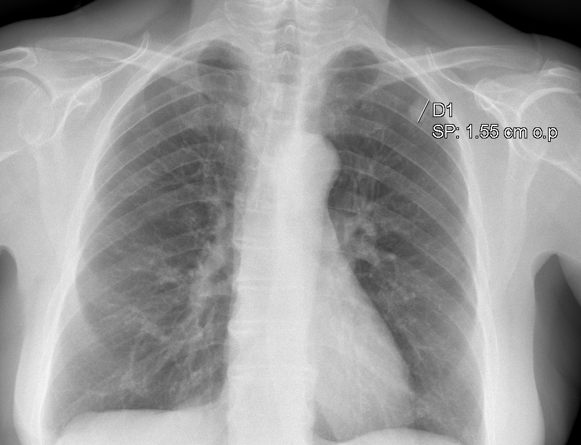 nucleololailo's tweet photo. 2) 
Coin lesions on chest X-ray) (1) under the microscope reveal infarct-like necrosis (2) with a rim of fibrosis, chronic inflammation with/out granulomatous reaction and MGCs (3)
Inside, a pulmonary artery with the worm in the lumen, better or worse preserved/calcified (4) https://t.co/n7VTocM8VV