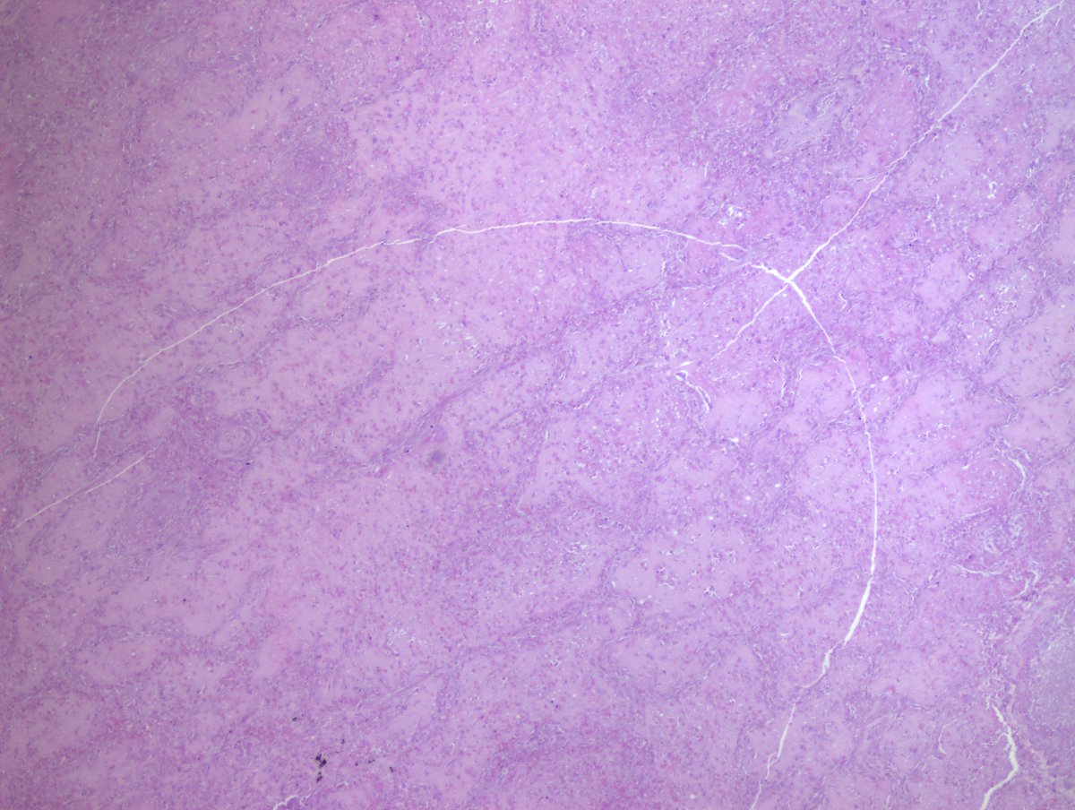 nucleololailo's tweet photo. 2) 
Coin lesions on chest X-ray) (1) under the microscope reveal infarct-like necrosis (2) with a rim of fibrosis, chronic inflammation with/out granulomatous reaction and MGCs (3)
Inside, a pulmonary artery with the worm in the lumen, better or worse preserved/calcified (4) https://t.co/n7VTocM8VV