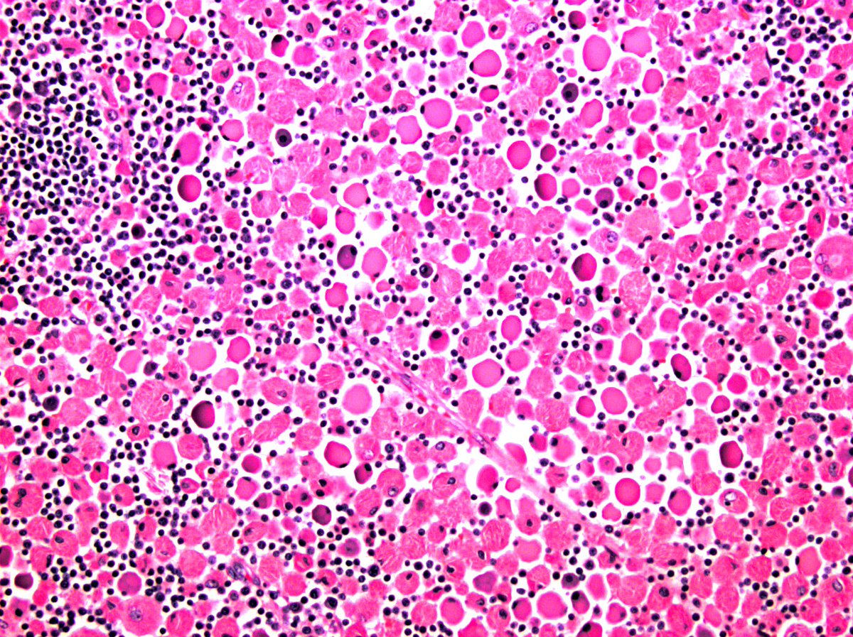 hemepathguy's tweet image. #hemepath This one is for @IHC_guy. What's the diagnosis? LN, Older male. Maybe more than one thing going on?