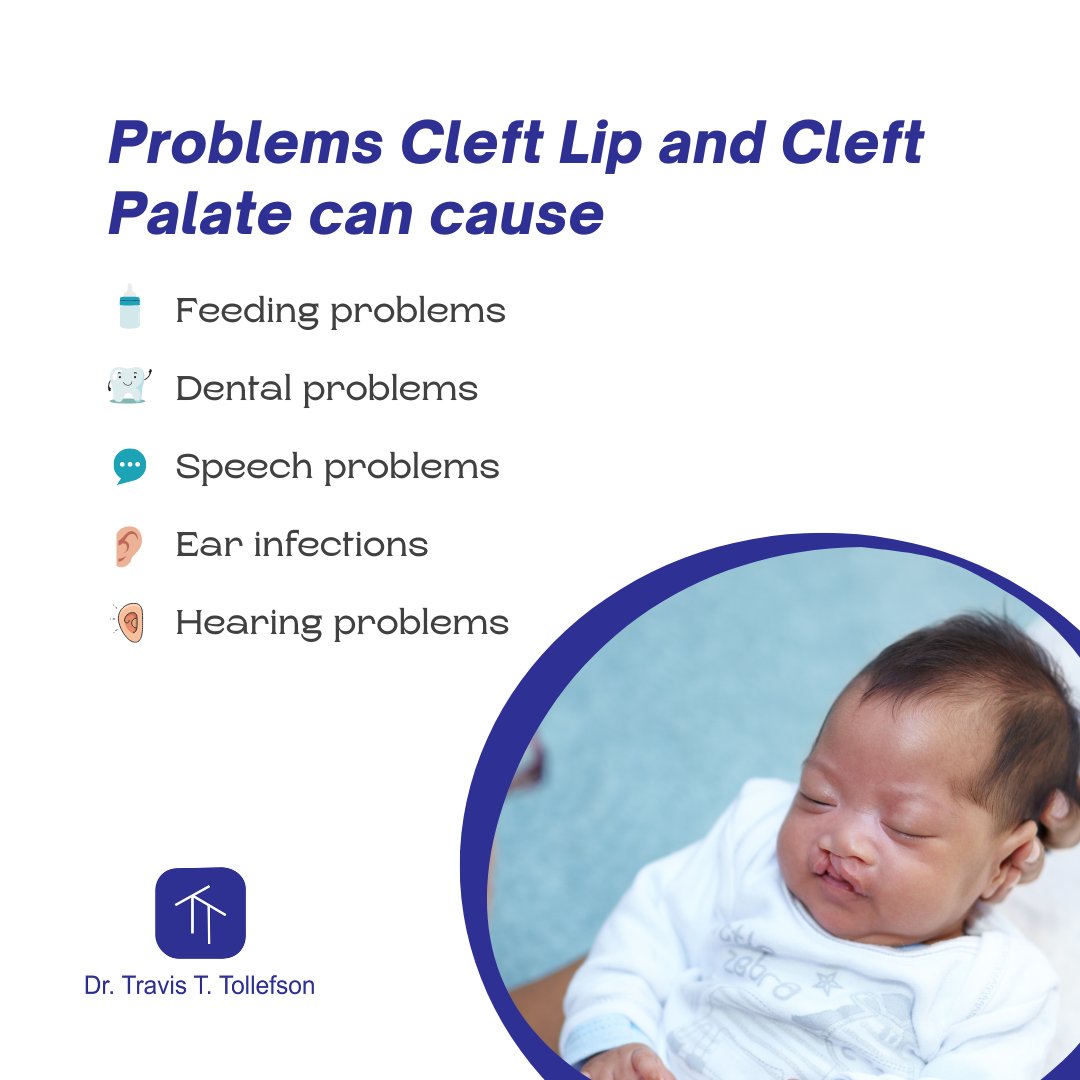 Cleft lip and palate are among the most common birth defects in the US. These conditions can cause various problems for the child, including: