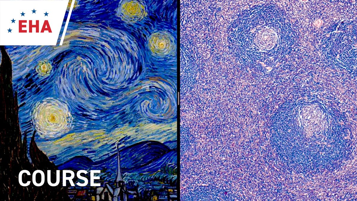 On #CastlemanDiseaseDay, EHA is releasing a freely accessible #EHACampus course on this rare disease. Learn all about CD in 6 bite-size modules and 2 interactive activities. Check it out here: ehaedu.org/CastlemanDisea…