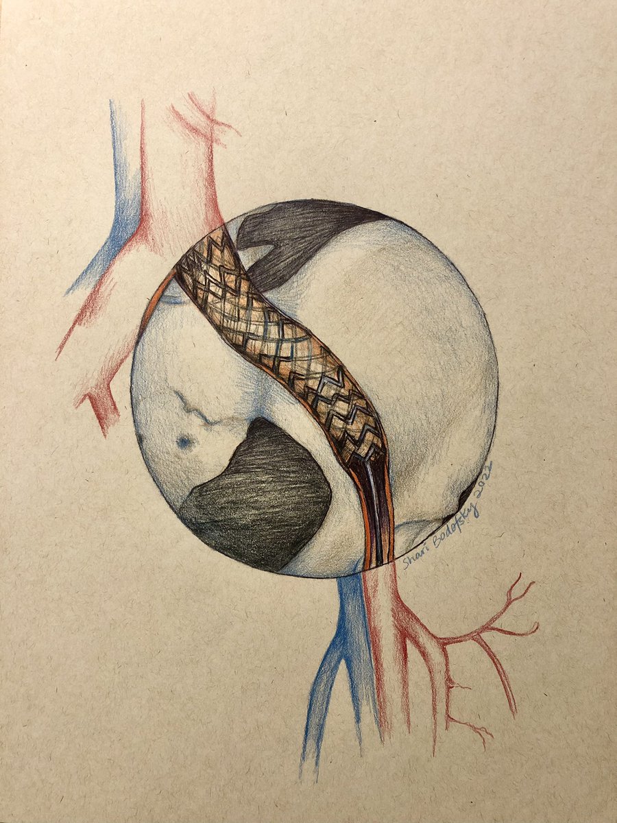 ShariBodofsky's tweet image. Just finished my first block of intern year, vascular surgery. I can genuinely say I learned a lot and met amazing people. Now I’m heading to the floors, wish me luck 
#intern #transitionalyear #vascularsurgery #medicalillustration