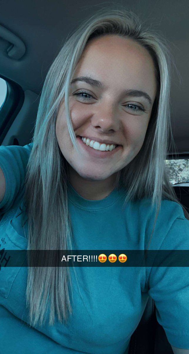 Got my Invisalign taken off yesterday and I’m IN LOVE with my smile now🤍