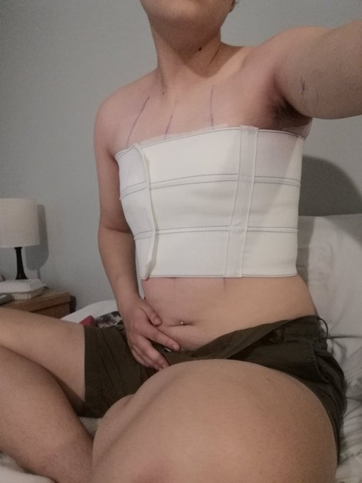 A bit of an update for you guys! I got top surgery today!! Im sore and in a bit of pain but otherwise<a href="/tag/nsfwtwt"class="tags"><span>#nsfwtwt</span></a>