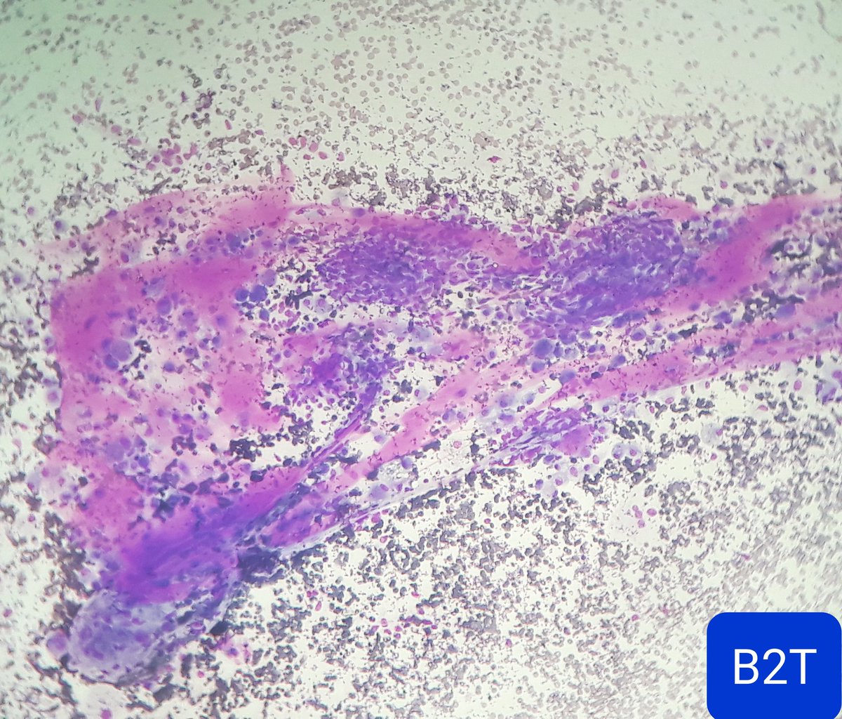 Cytopathology image of "chewing gum" colloid from a case of Papillary carcinoma of thyroid. #PathTwitter #pathology #thyroid