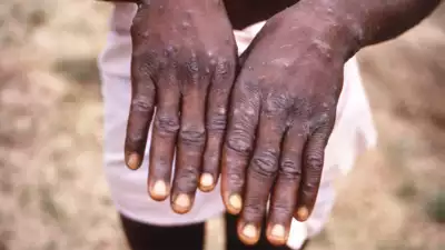 TimesNow's tweet photo. #Breaking | WHO recognizes #Monkeypox outbreak as  a 'public health emergency of international concern', announces WHO DG Dr #TedrosAdhanom https://t.co/k9B4PCb6ut