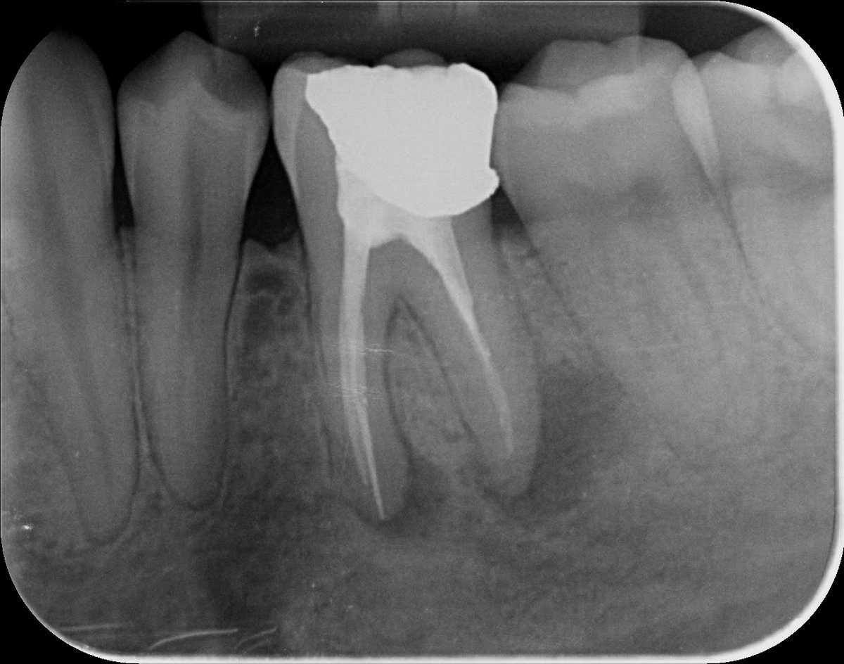 johnrhodesendo's tweet photo. Here in Endoland it's Saturday Surgery and reRCT LL6 with fractured file removal using BTR Pen 🙂
#savingteeth #endodontics
first review will be 6 months https://t.co/7lodNAjDtl