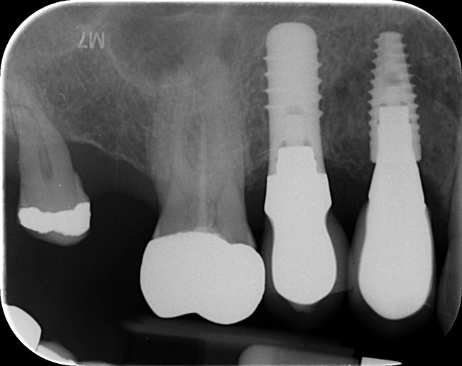 Blasting away pulpal calcification to locate the root canals during reRCT UR6
Check out the video! 🤣
youtu.be/y25fenwHwms