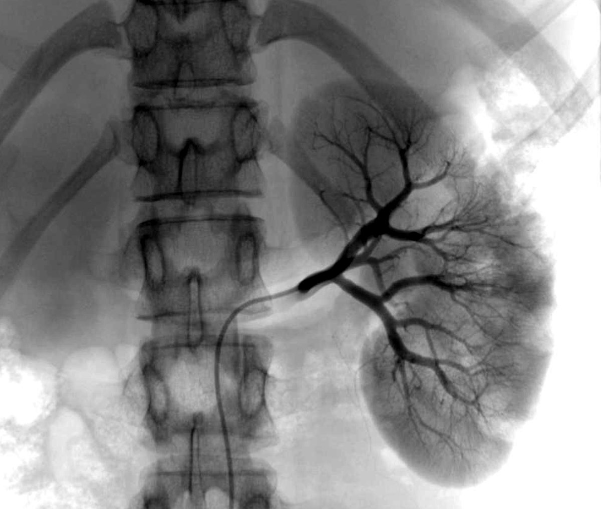 IR_Juniors's tweet photo. #TipsForNewDocs
#TipsforFYs
Why are radiologists so concerned about the renal function before giving contrast?
Tweetorial Thread Two
(π§΅/12) https://t.co/Gwi8tYQjSh