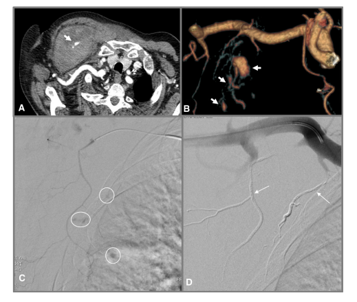 #ShortCommunication
Spontaneous Haematomas in Anticoagulated #Covid-19 Patients: Diagnosis and Treatment by #Embolization
link.springer.com/article/10.100…