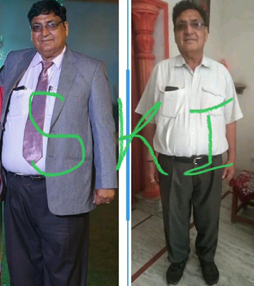 Hb1ac from 12.2 % to 6.1 % , body weight from 127 kgs to 93 kgs. Stopped amlodipine 5 mg. Stopped insulin 44 units and 2 other pills for T2D , only on a 10 mg sglt2 inhibitor.<a href="/DrPaulMason/">Paul Mason MD</a> <a href="/aga_pallavi/">Dr. Pallavi Aga</a> <a href="/SBakerMD/">Dr Shawn Baker 🥩</a> <a href="/drjasonfung/">Dr. Jason Fung</a> <a href="/maheklokhandwa2/">indian_carnivore</a> <a href="/ifixhearts/">Heart Surgeon Dr. Philip Ovadia</a> <a href="/pran_dr/">Dr Pran Yoganathan</a>