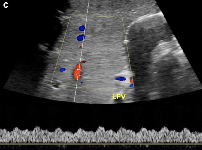 noorfmb's tweet photo. Normal portal vein:
1. Monophasic
2. Continuous hepatopetal flow
3. Mild cardiac &amp; respiratory phasicity
4. Mean velocity 15-18 cm/s
5. Diameter: 13-16 mm

Caliber change of 5 mm at the anastomotic site is insignificant.

Vel >50cm/s is common due to post op edema/size mismatch https://t.co/Ak5OQwn1Fn