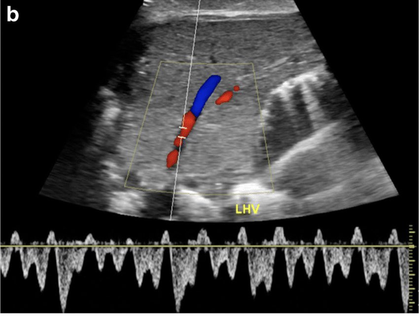 noorfmb's tweet photo. Normal hepatic vein:
1. Triphasic waveform owing to right atrial contractions.

Loss of phasicity can occur in early post op period due to graft edema. 

@samrad77 https://t.co/D60NQxk0el
