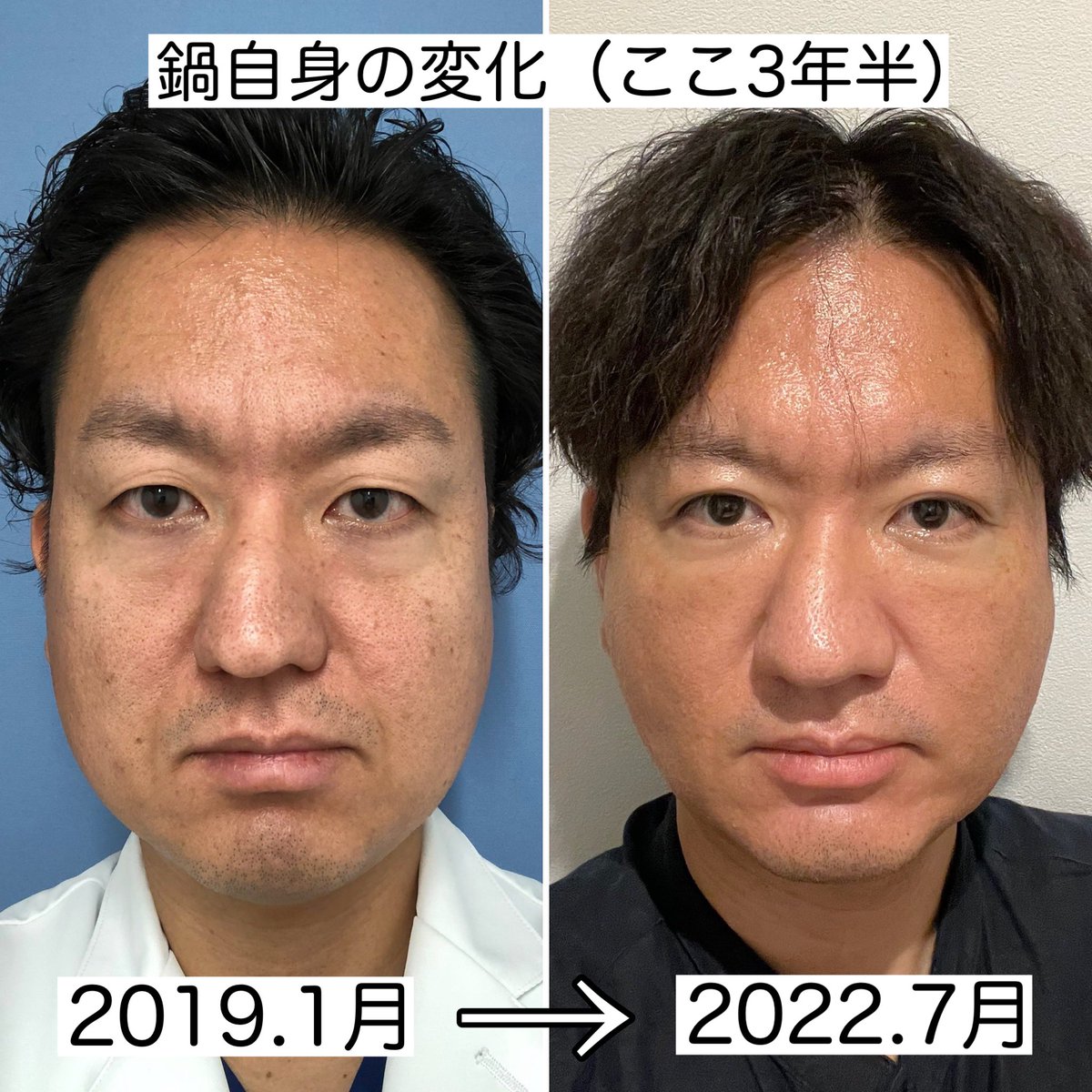 ベビースキン(臍帯血幹細胞培養上清液)のSNS口コミ☆3.81(214 ベビースキン(臍帯血幹細胞培養上清液)のSNS口コミ☆3.81(214