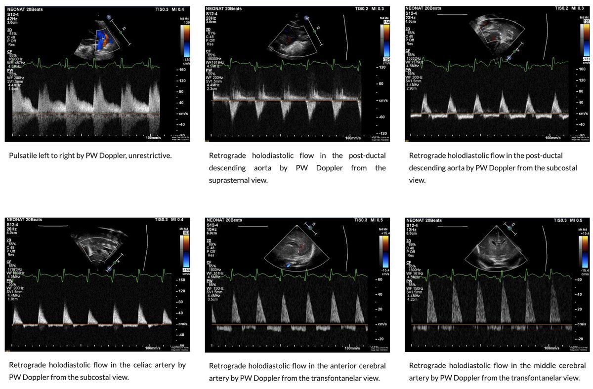 Some Echo-Doppler signs of ductal systemic steal from the systemic to the pulmonary circulation. Here, in the case of extreme prematurity. Read/see more on NeoCardioLab PDA section neocardiolab.com/tnecho_1/paten… <a href="/ScotNeoPOCUS/">Scottish Neonatal Haemodynamics & POCUS Group</a> <a href="/NicuPocus/">NicuPocus</a> <a href="/NeoHemodynamics/">Neonatal Hemodynamics Research Centre</a> <a href="/NeoHeartSociety/">Neonatal Heart Society</a> <a href="/HebertAudrey3/">Audrey Hebert</a>