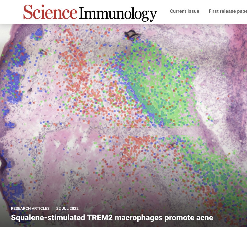 IforRWilliams's tweet photo. A deep dive into the mechanisms of #acne by the Modlin lab @dgsomucla using #SpatialTranscriptomics & #SeqScope finds TREM2 MØs stifled in their killing of C. acnes by the lipid squalene.
Link to read article ⬇️
https://t.co/gepqOE6Evq https://t.co/MLlWNCCdnW