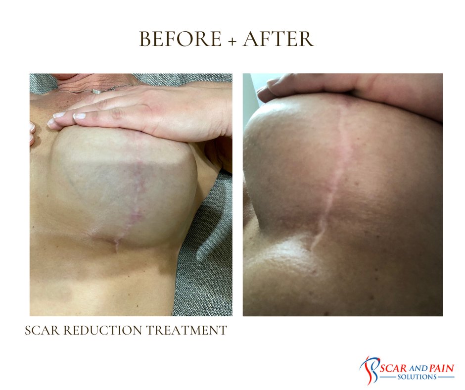 ErikFAnderson's tweet photo. Breast Reduction and lift scar reduction. https://t.co/0ZBUai6Mac